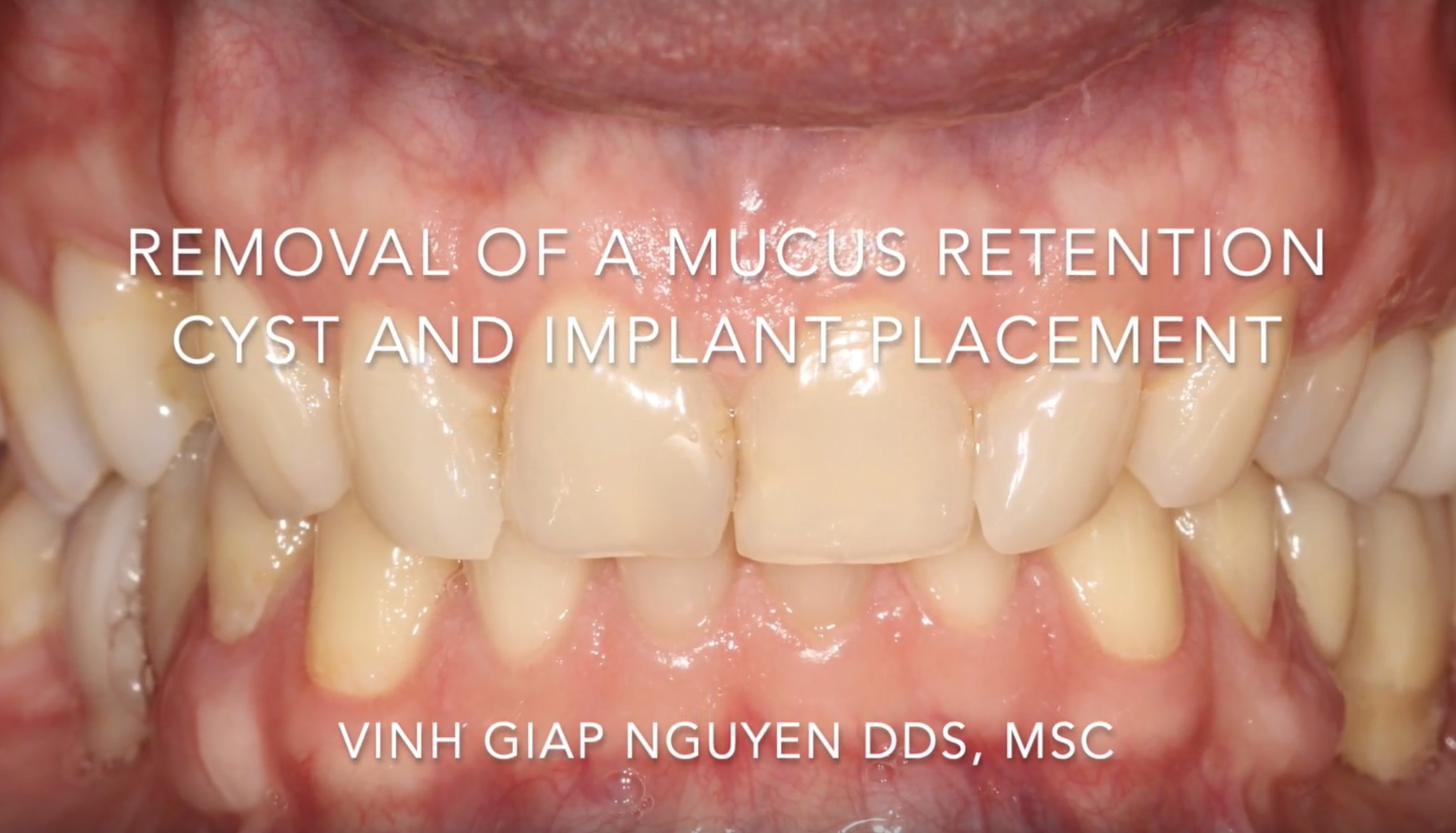 Maxillary Sinus Cyst Removal